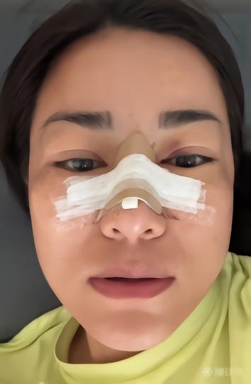 李佳悦_中国女足李佳悦 加拉塔萨雷 鼻梁骨骨折